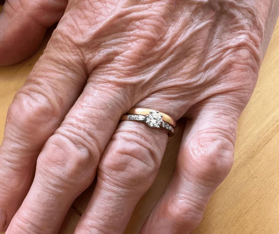Sejarah dan Makna Arthritis Wedding Rings